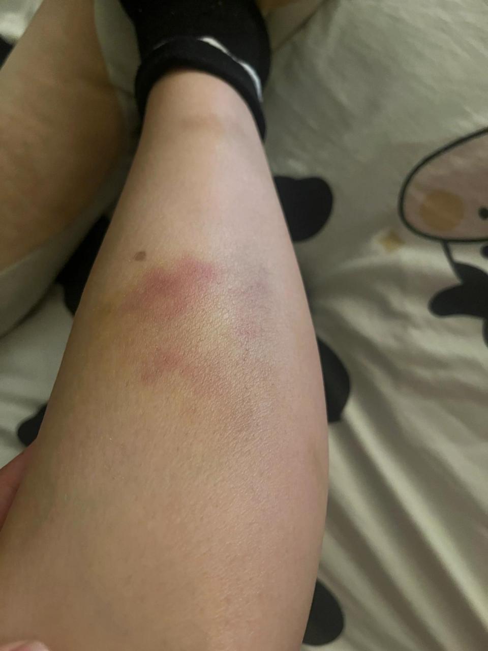 电动车被车撞,肌肉软组织损伤,怎么理赔 今年5月底