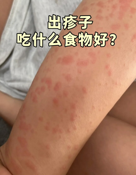 食物过敏皮疹图片发高烧出疹类型食物过敏起红疹要多长时间才消蛋白质