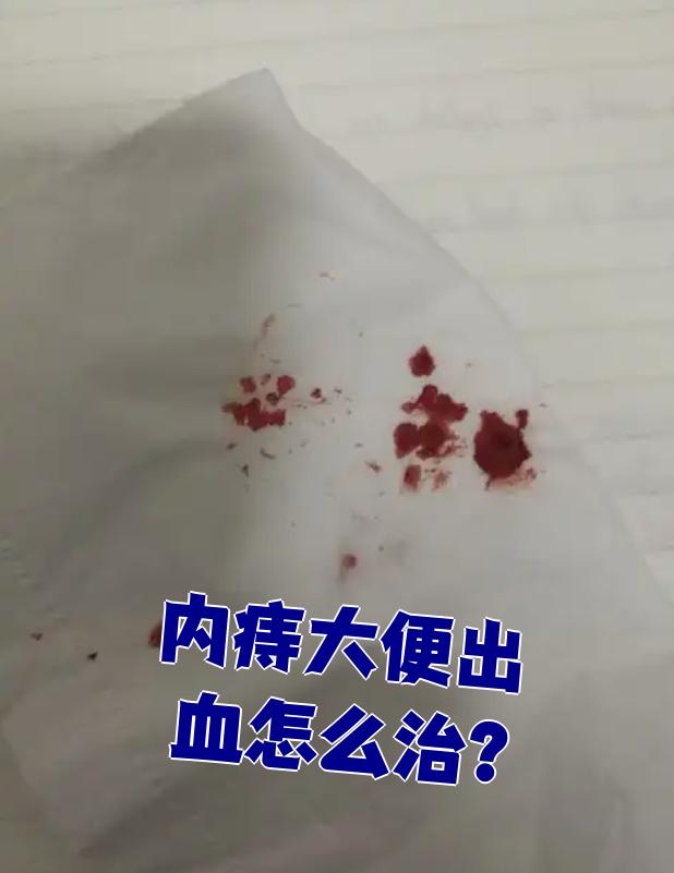 内痔大便出血的治疗方法主要有三种:一般治疗,药物治疗和手术治疗