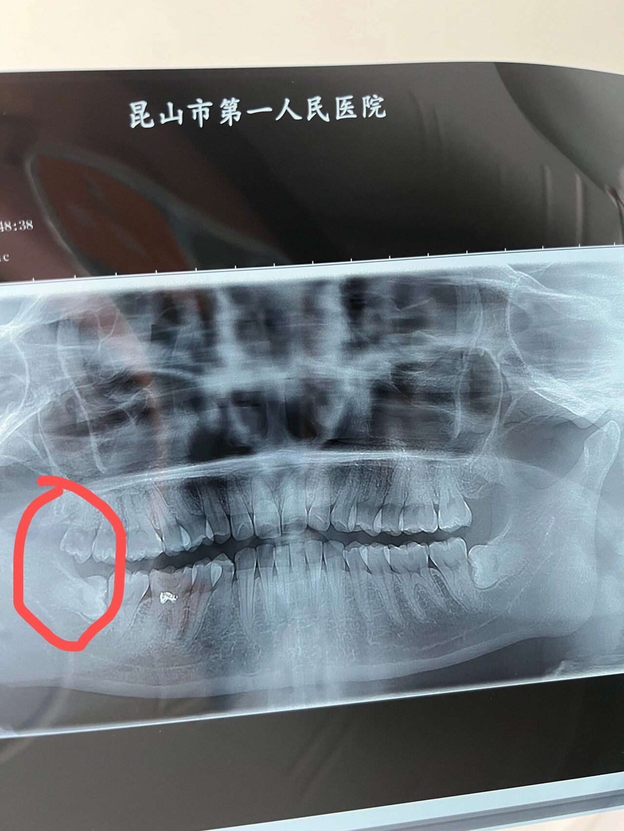 第一人民医院拔阻生齿(二)费用总结 费用: 挂号0 麻醉(社保卡9.