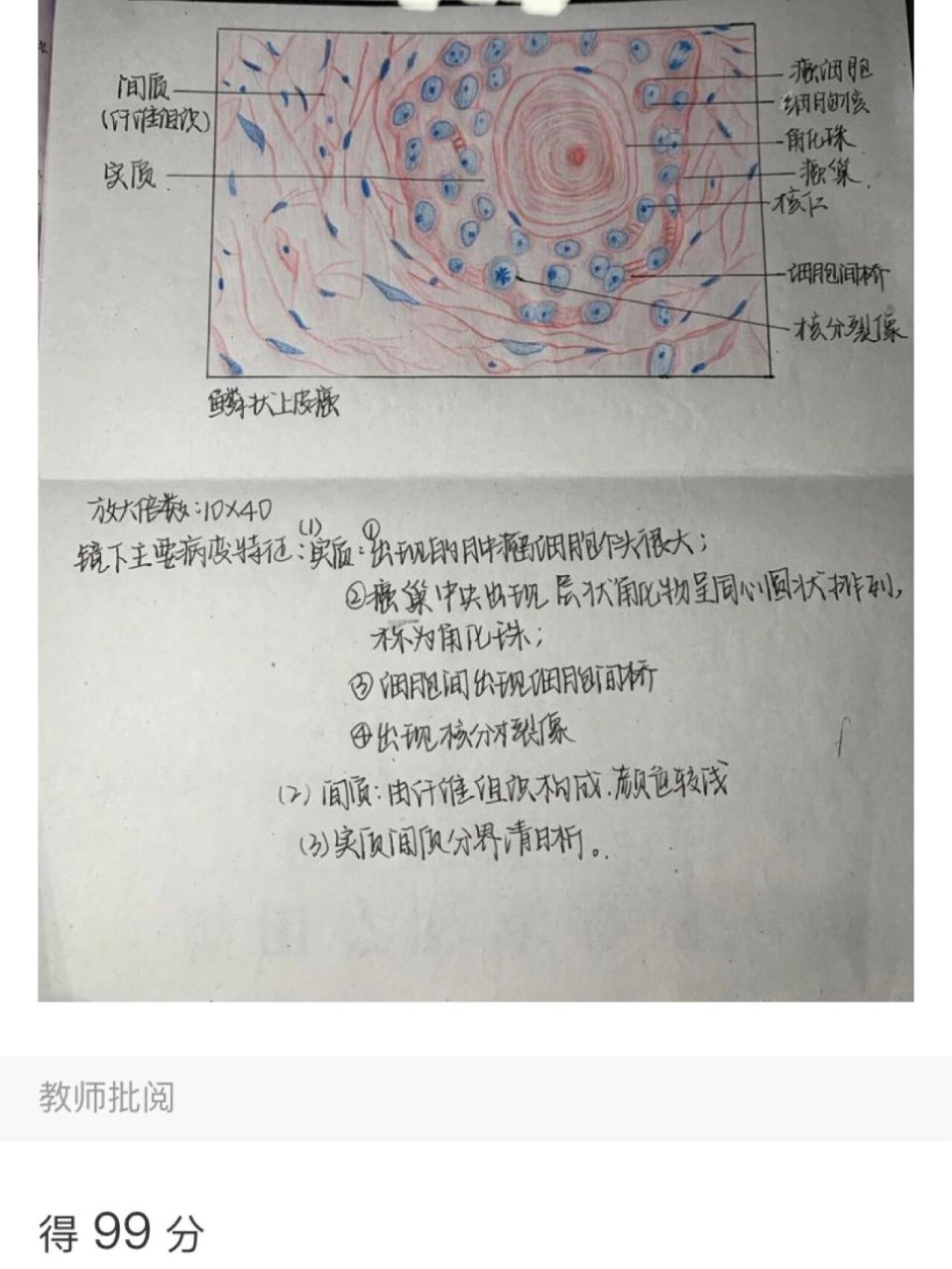【病理学】红蓝铅笔图 鳞状上皮细胞癌和风湿性心肌炎的病理切片 一个