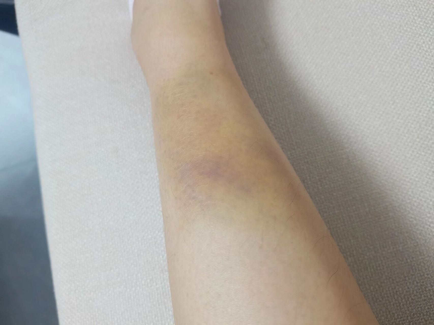 摔伤出现的淤青 我下楼梯没踩好小腿直接迎面跪在楼梯边上了,当时特别