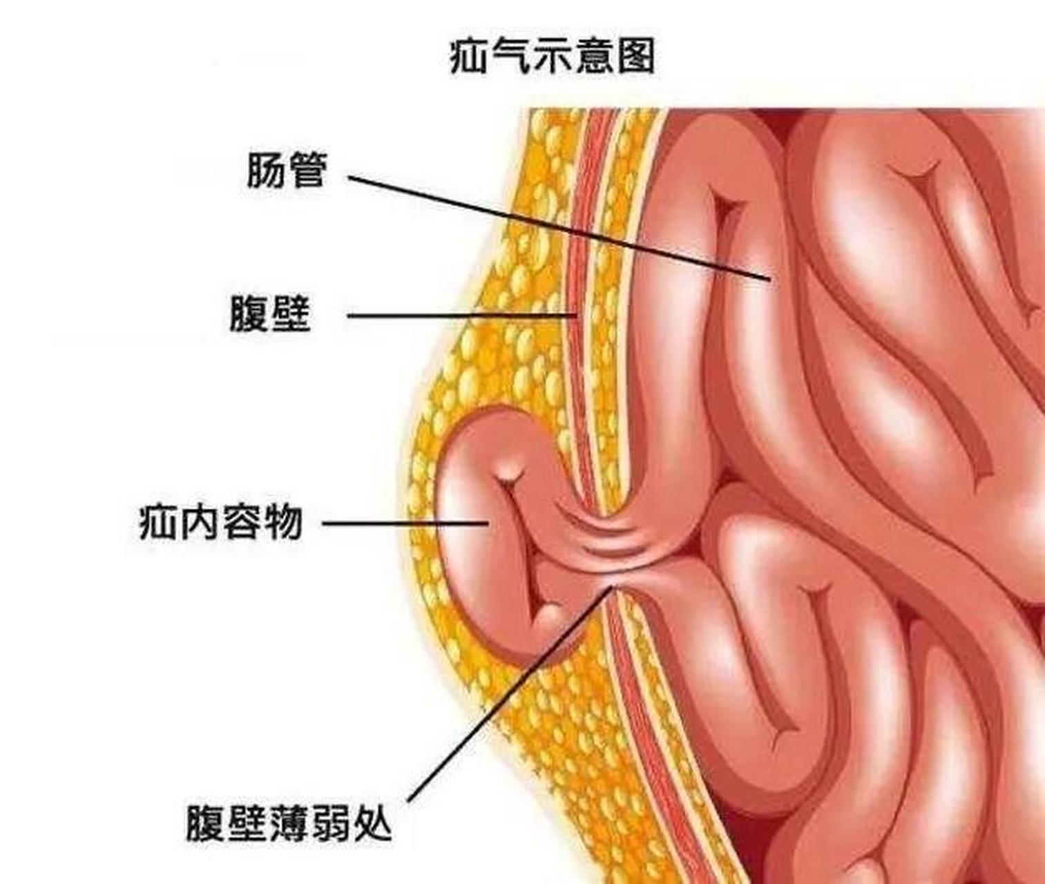 小肠袢图片图片