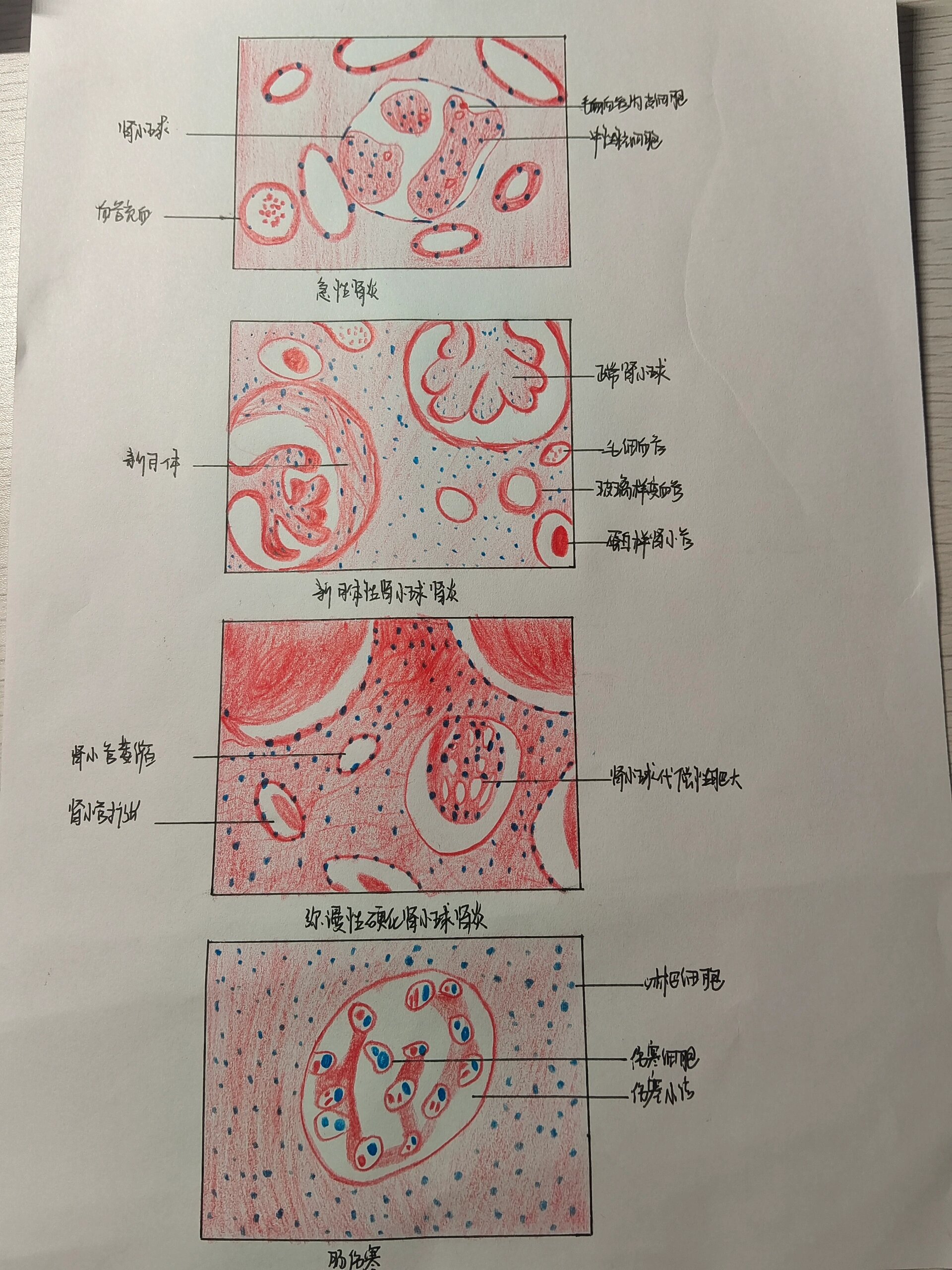 病理切片,红蓝铅笔画图 急性肾炎 新月体性肾小球肾炎 弥漫性硬化肾