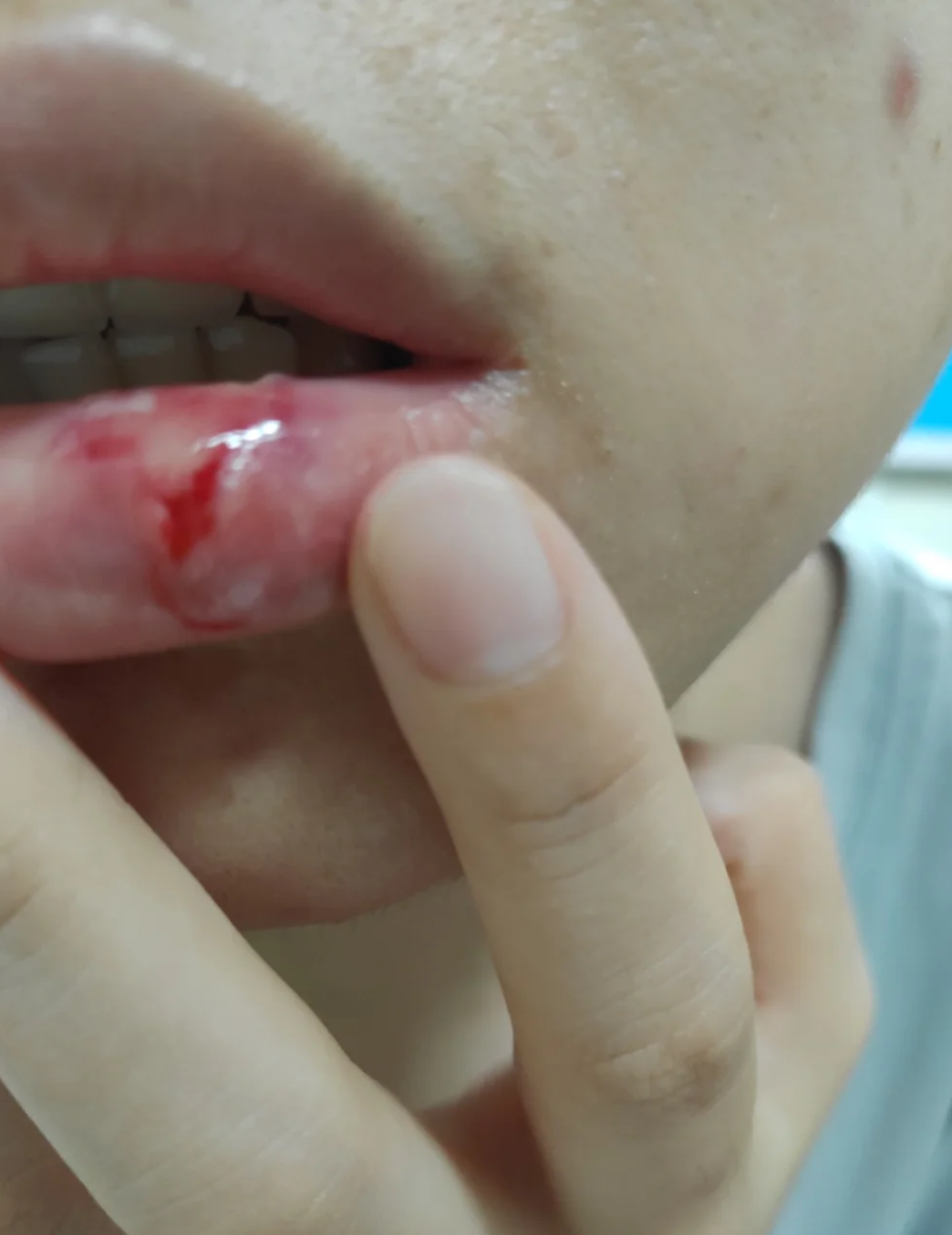 孩子嘴唇磕破了需要缝针吗?