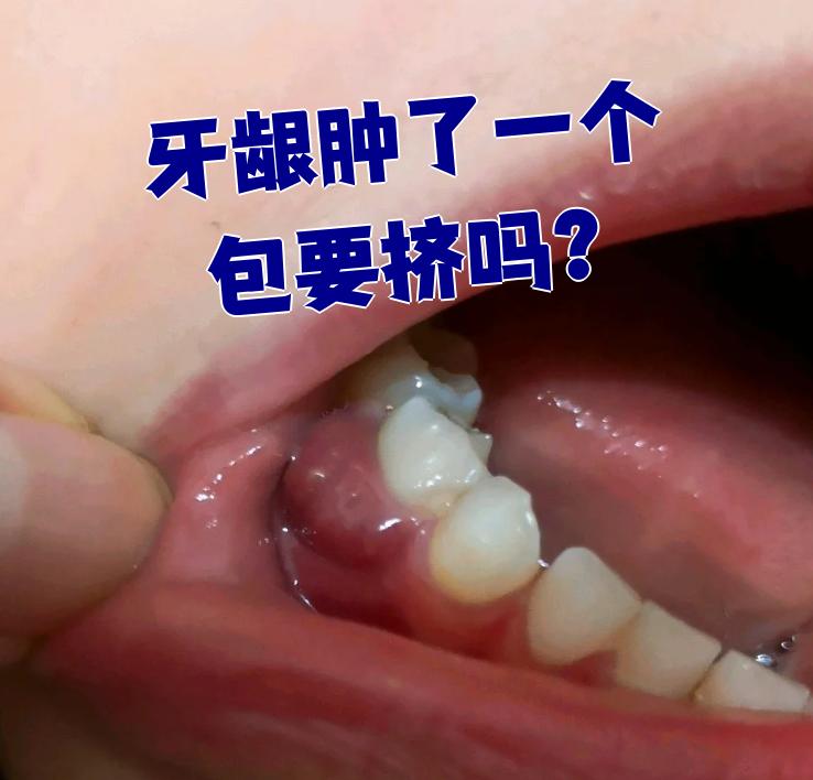 为什么牙龈突然肿了百科在线