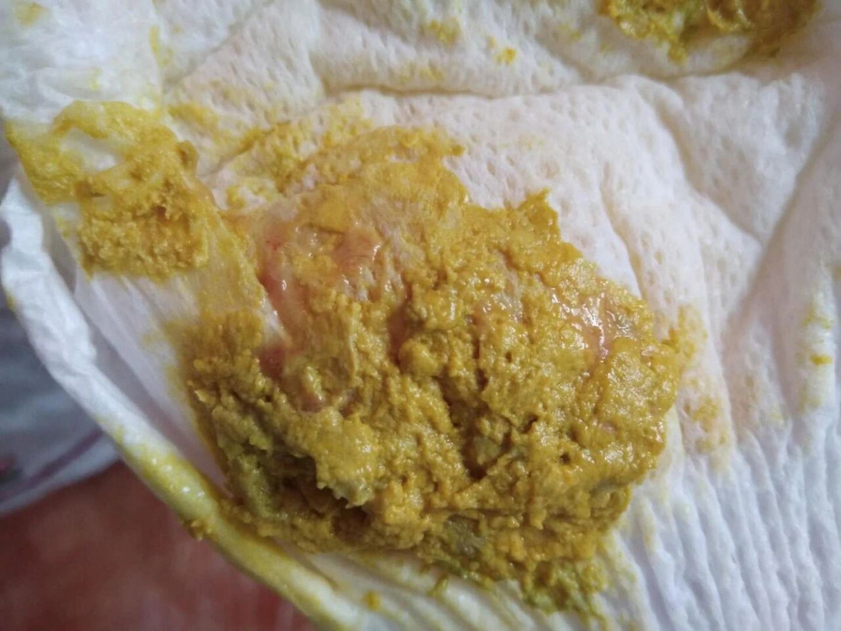 宝宝拉血丝和黏液不要怕!