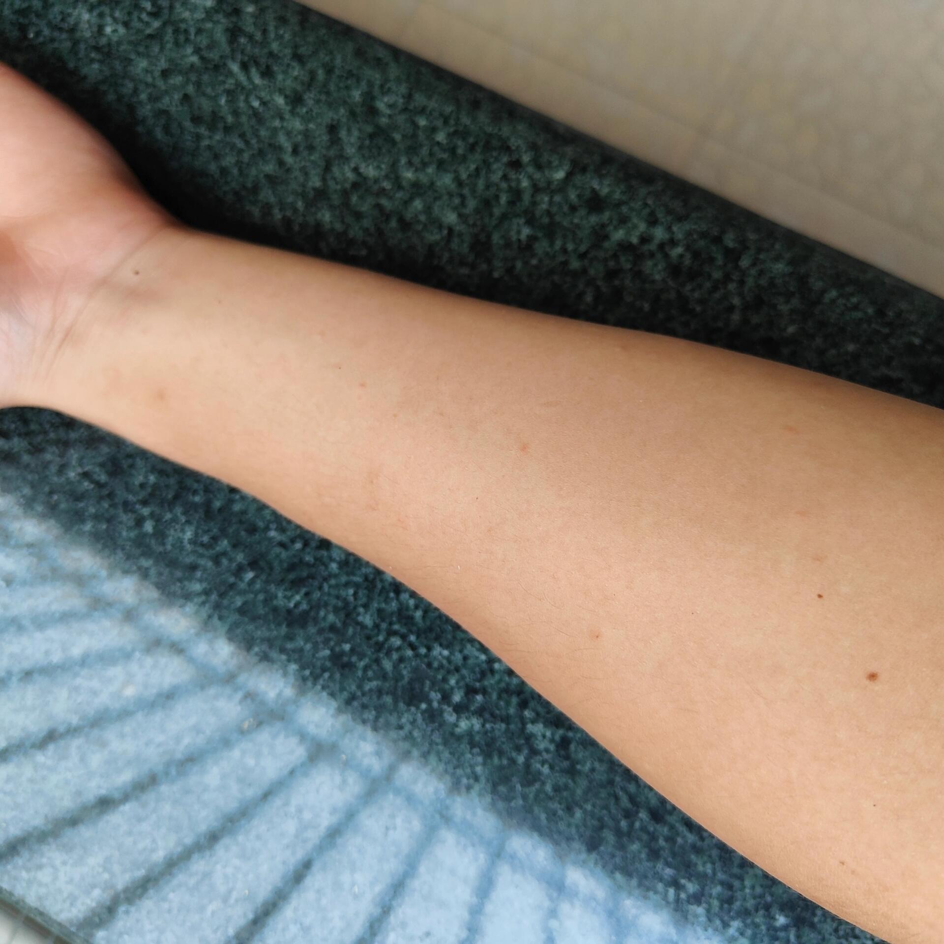 终究还是大漆过敏了 但是几天就消退了,也没有留痕迹,确实接触大漆