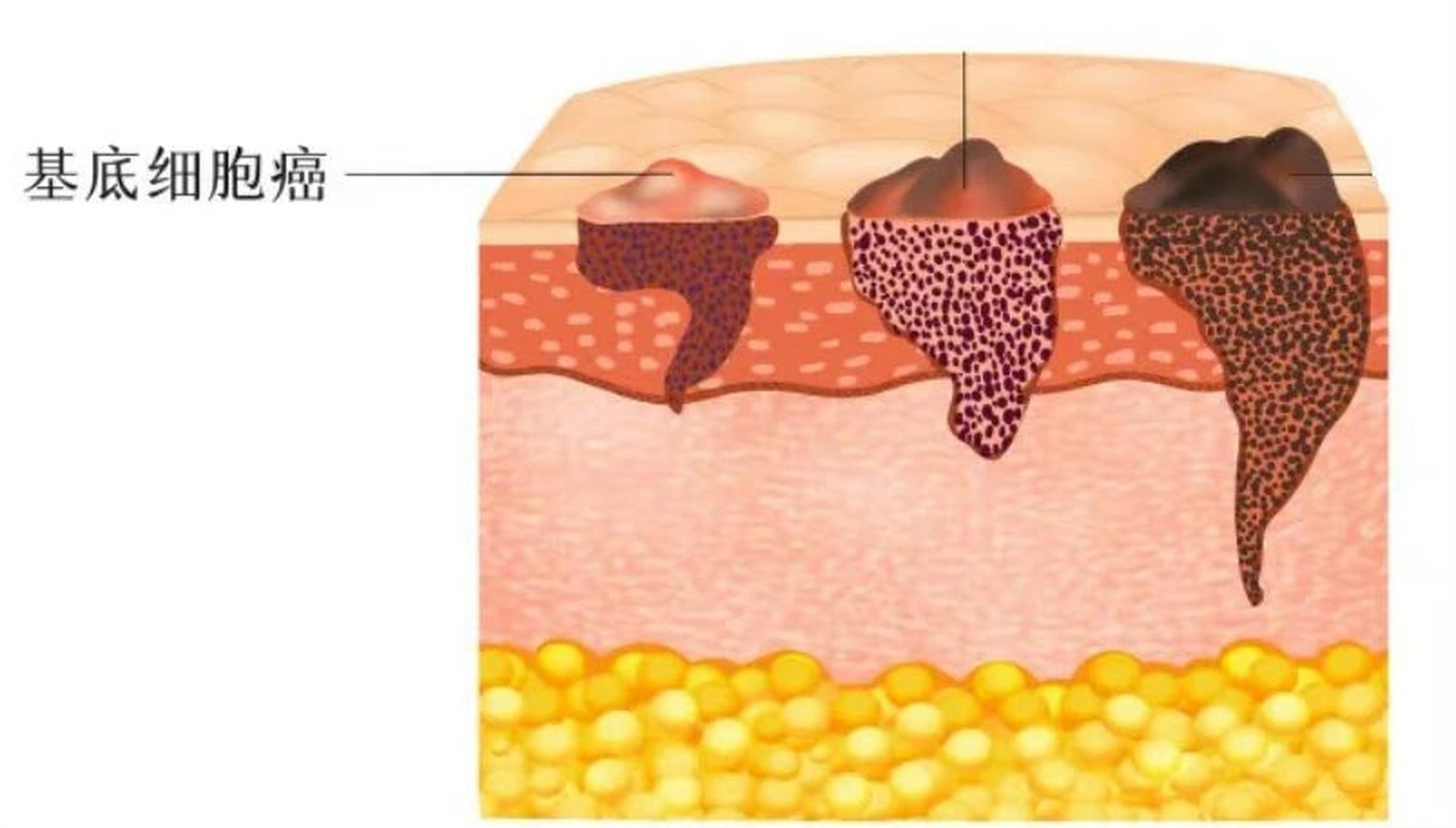 7474基底细胞癌又称基底细胞上皮瘤,是我国特别是日照较长的地区