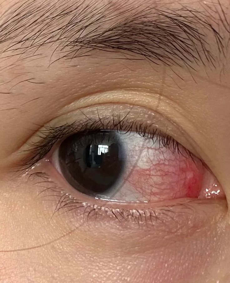 眼睛被打出红血丝通常能自己慢慢好,但被打伤可能还藏着其他问题,最