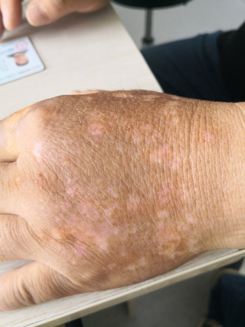 手背白癜风症状.可以使用药物治疗配合激光理疗复色.