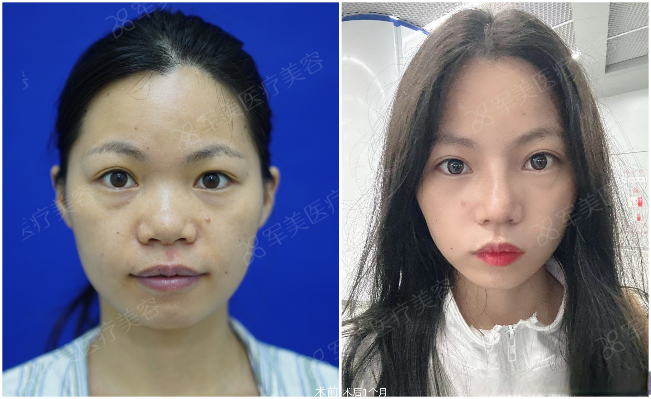 肋软骨隆鼻术后1个月与术前对比  小姑娘发过来的反馈照片,找了术前