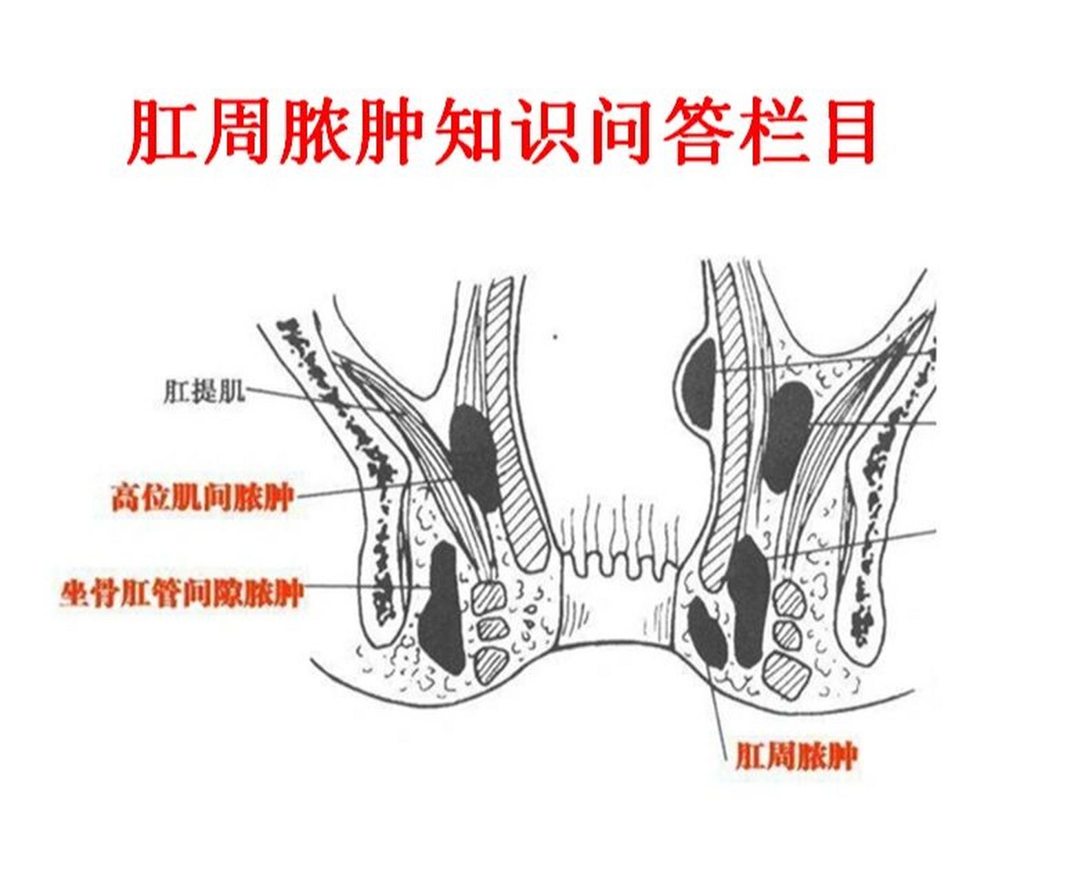 坐骨直肠间隙脓肿图片