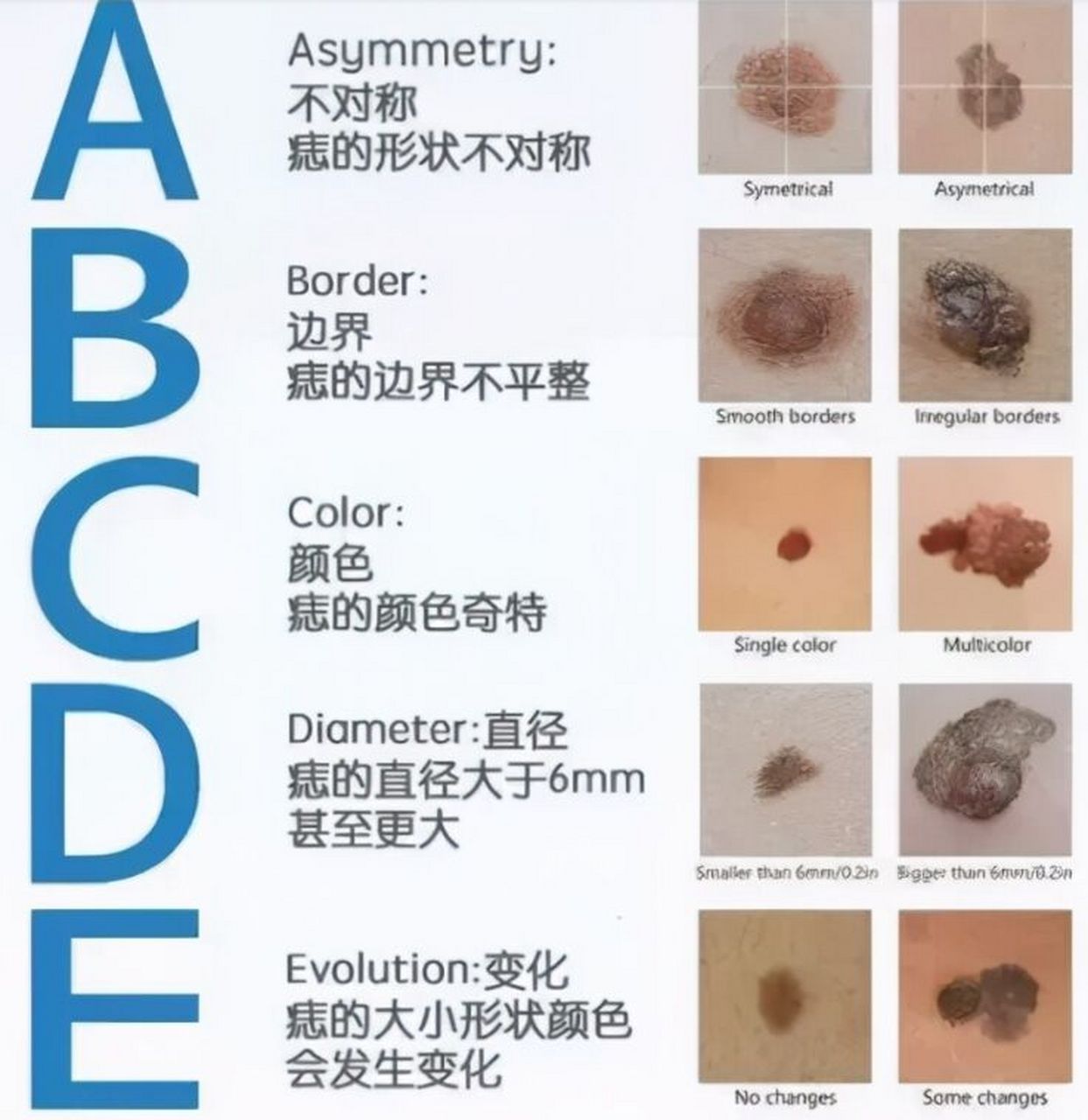 如何区分恶性痣?
