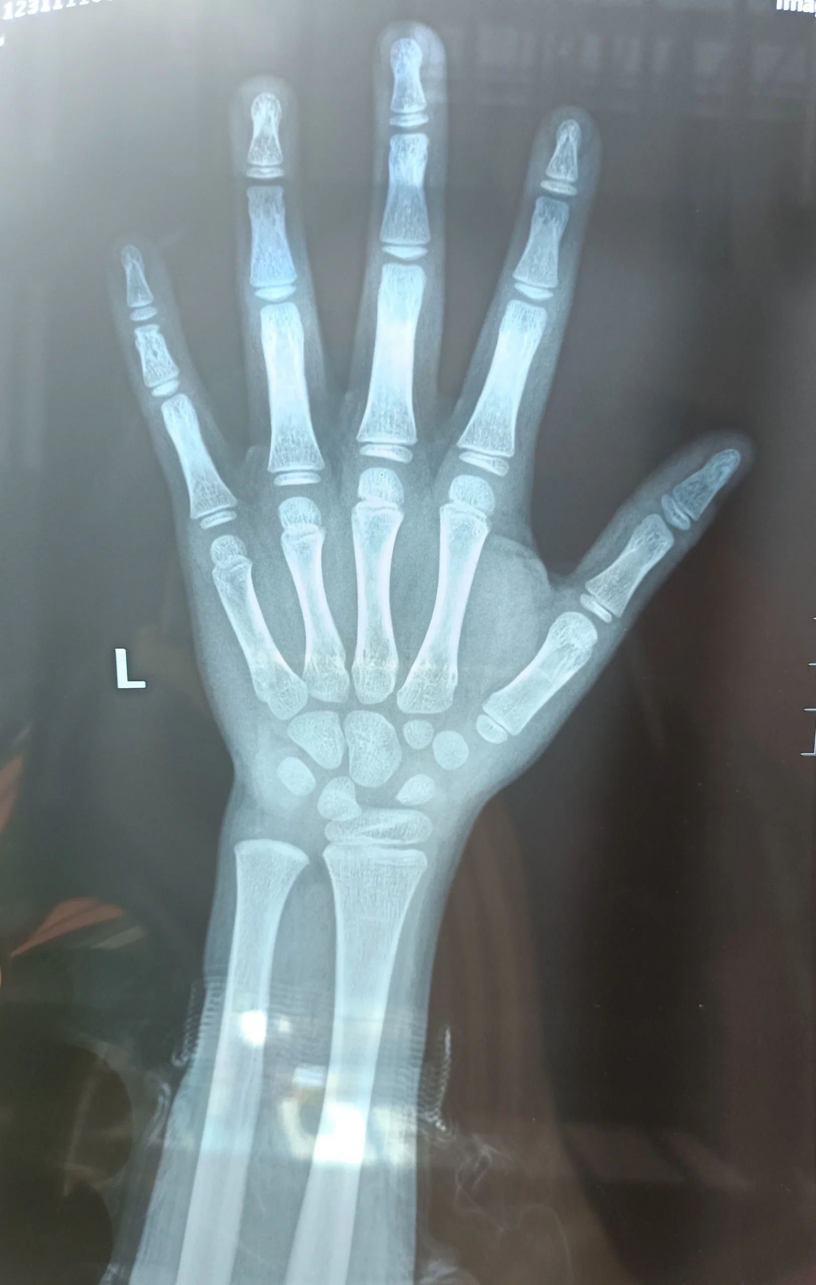 8岁11个月测了骨龄