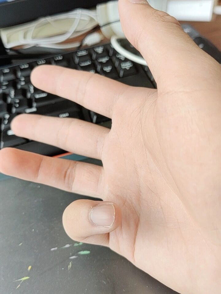 腱鞘炎小拇指怎么治疗,不想动刀子,求支招 本来是个小拇指,现在无名指