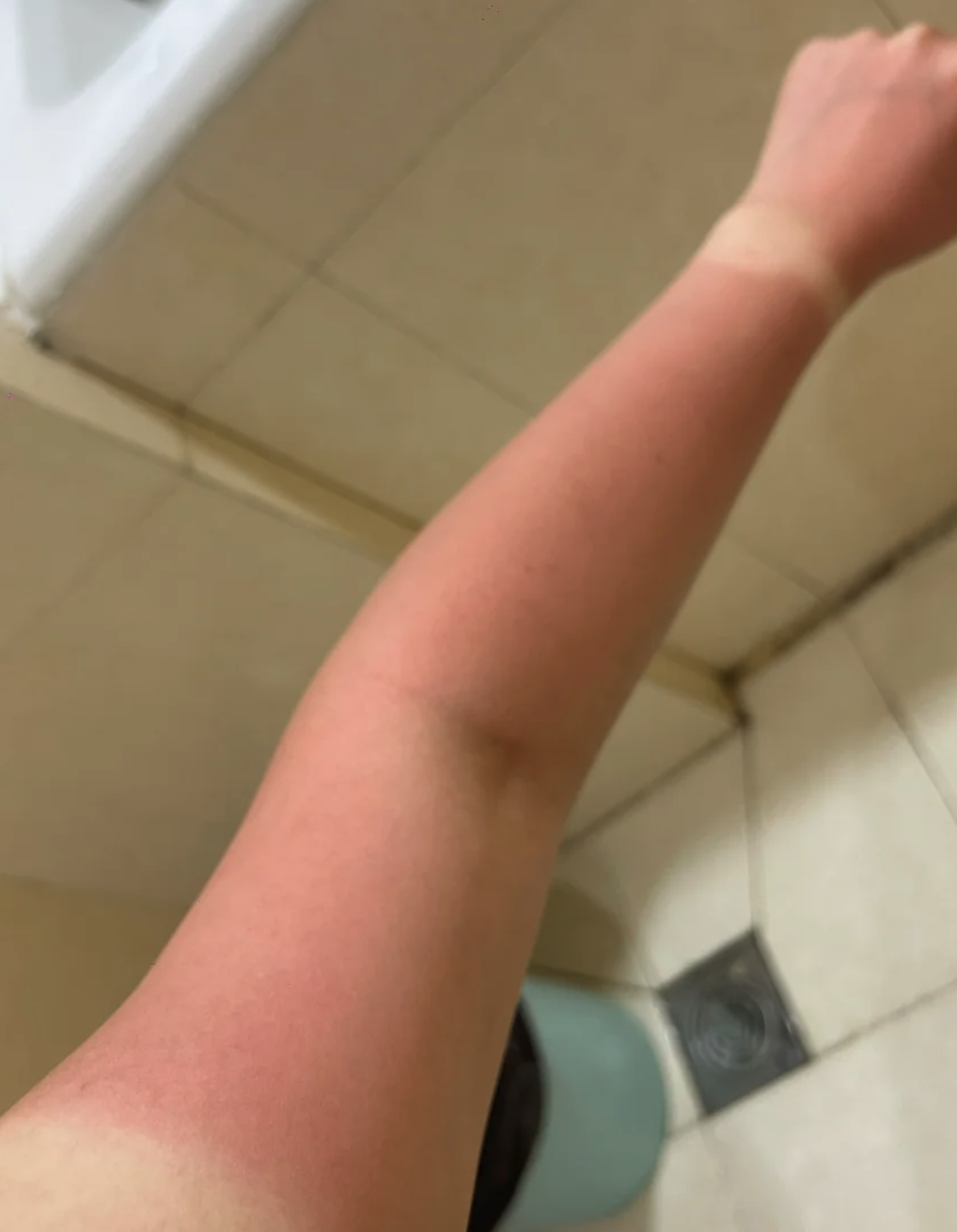 皮肤被紫外线晒伤后会出现发红,刺痛,这时候需要用温和的面膜来帮助