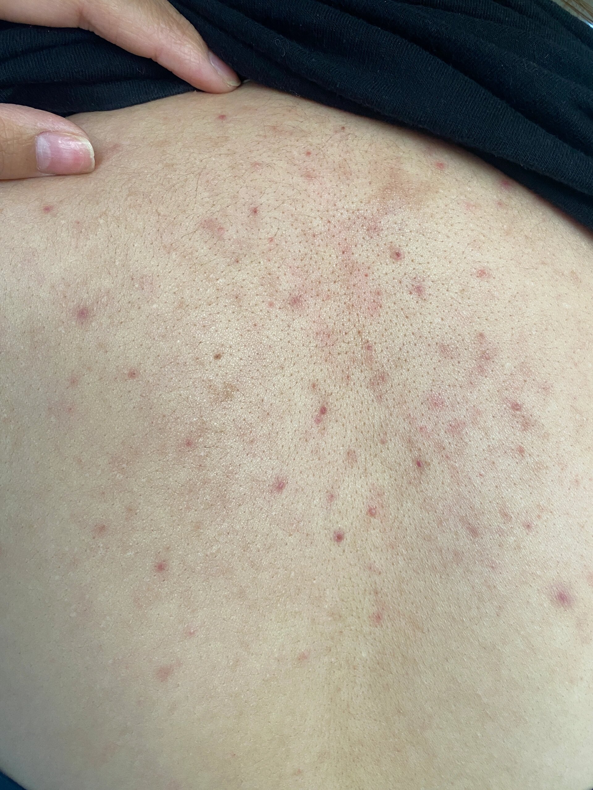 希望所有后背脂溢性皮炎的姐妹都能刷到!不 真的没想到这个介么牛掰!