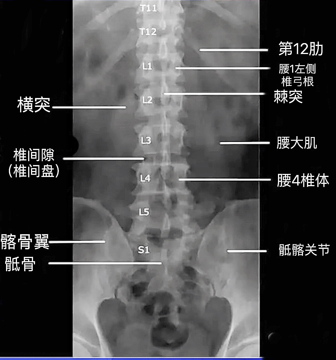 三张图让你看懂腰椎正常x线片