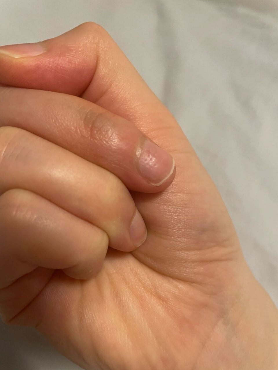 为什么指甲上有这种小坑点 前段时间突然发现右手中指
