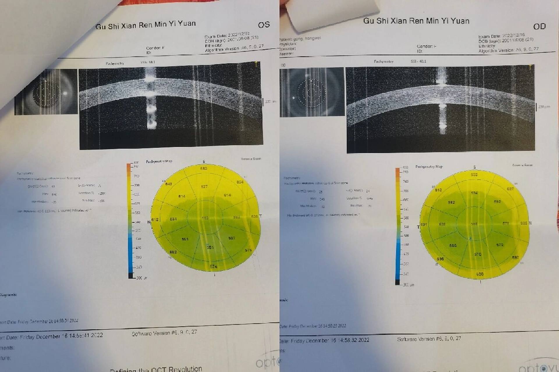 刚开始先是裂隙灯检查,有结膜炎,然后做了眼底照相和oct ,医生说看