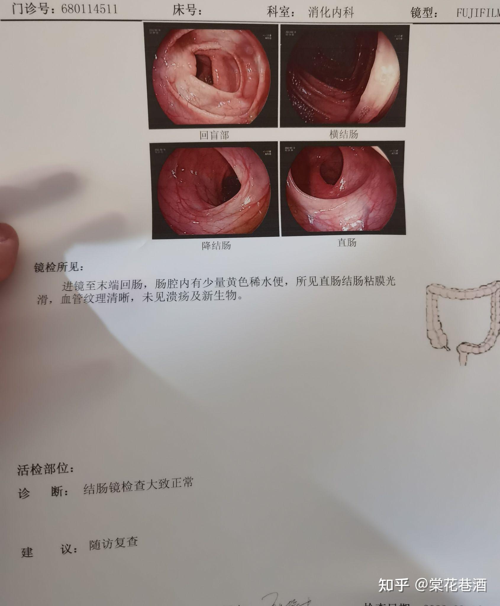 做肠镜是种怎样的体验