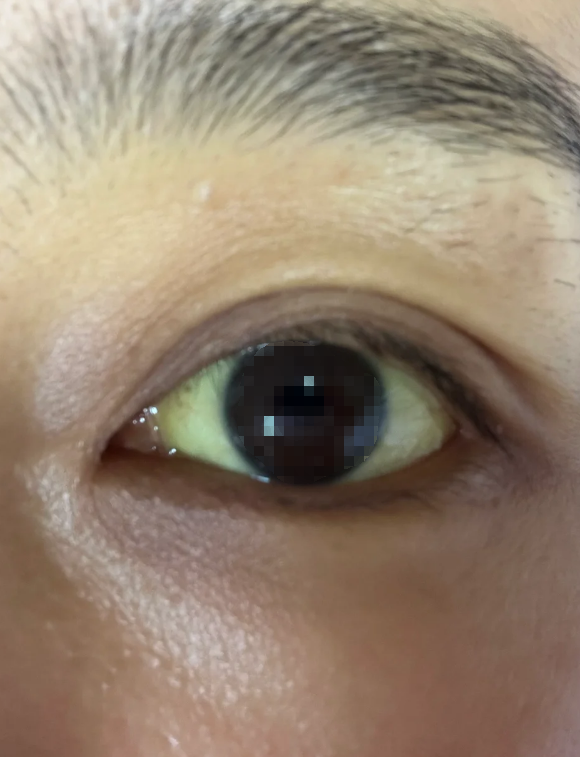 女性眼白发黄浑浊最常见的原因是黄疸和肝炎