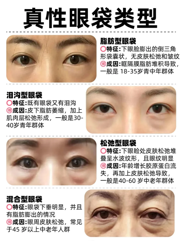 怎么没人替内切眼袋发声啊!