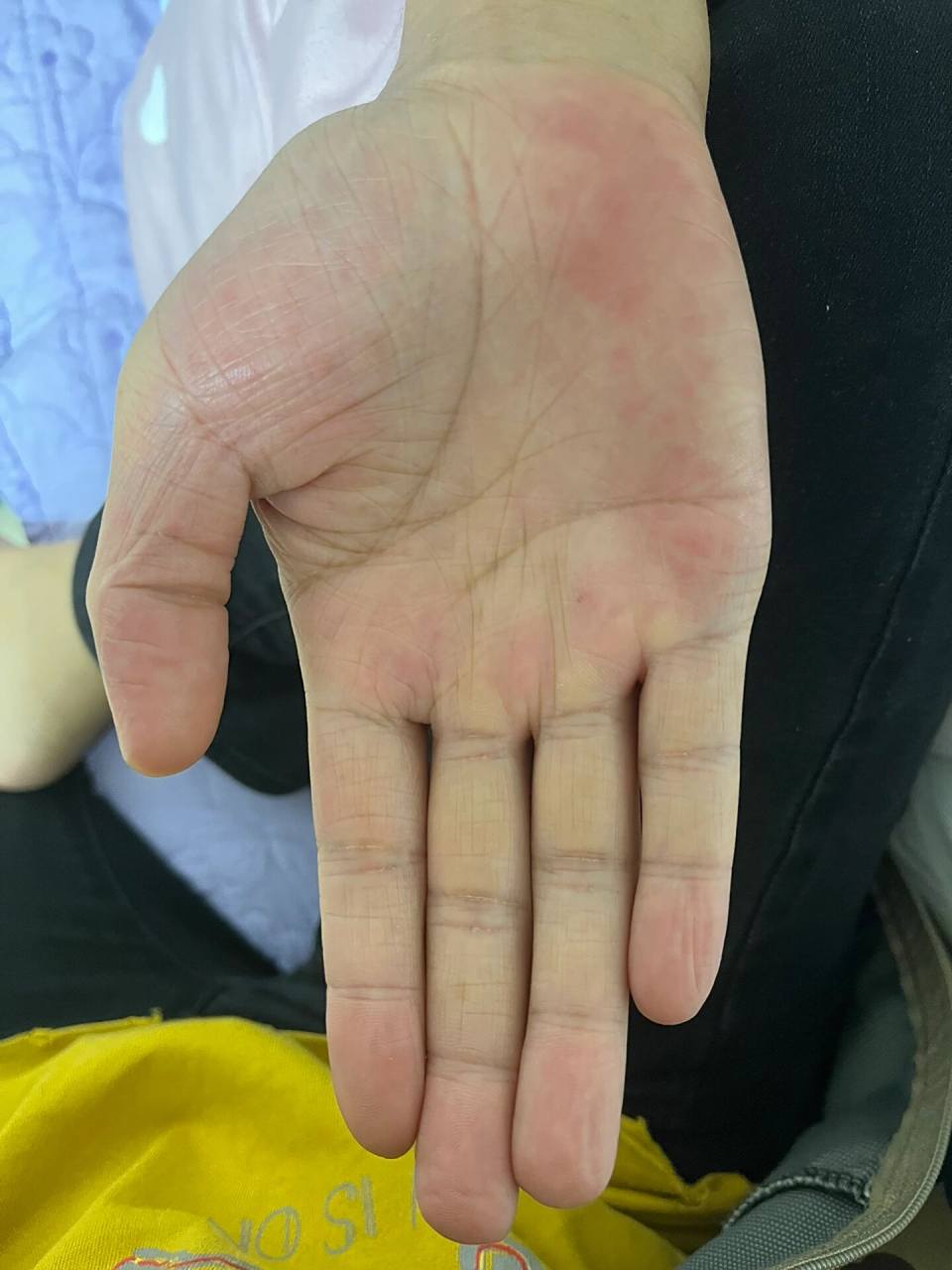 这是肝掌吗? 这是男朋友的手,可以帮忙看看是肝掌吗?