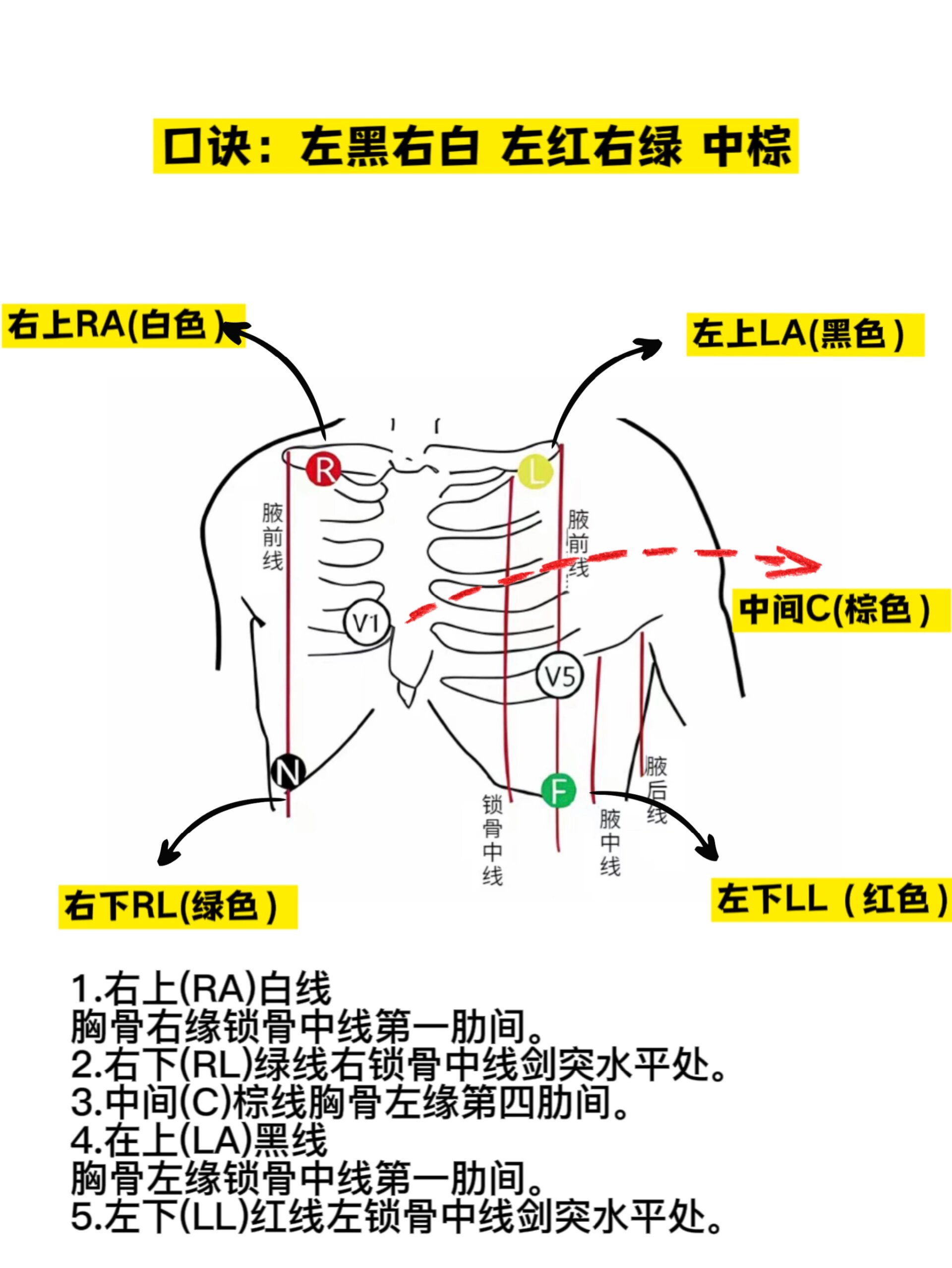 胸导联电极的安放位置图片