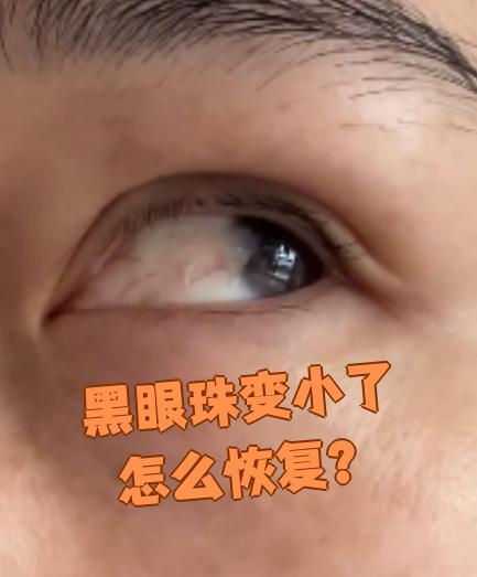 黑眼珠变小了怎么办?这要看具体原因.不同情况有不同的处理方法