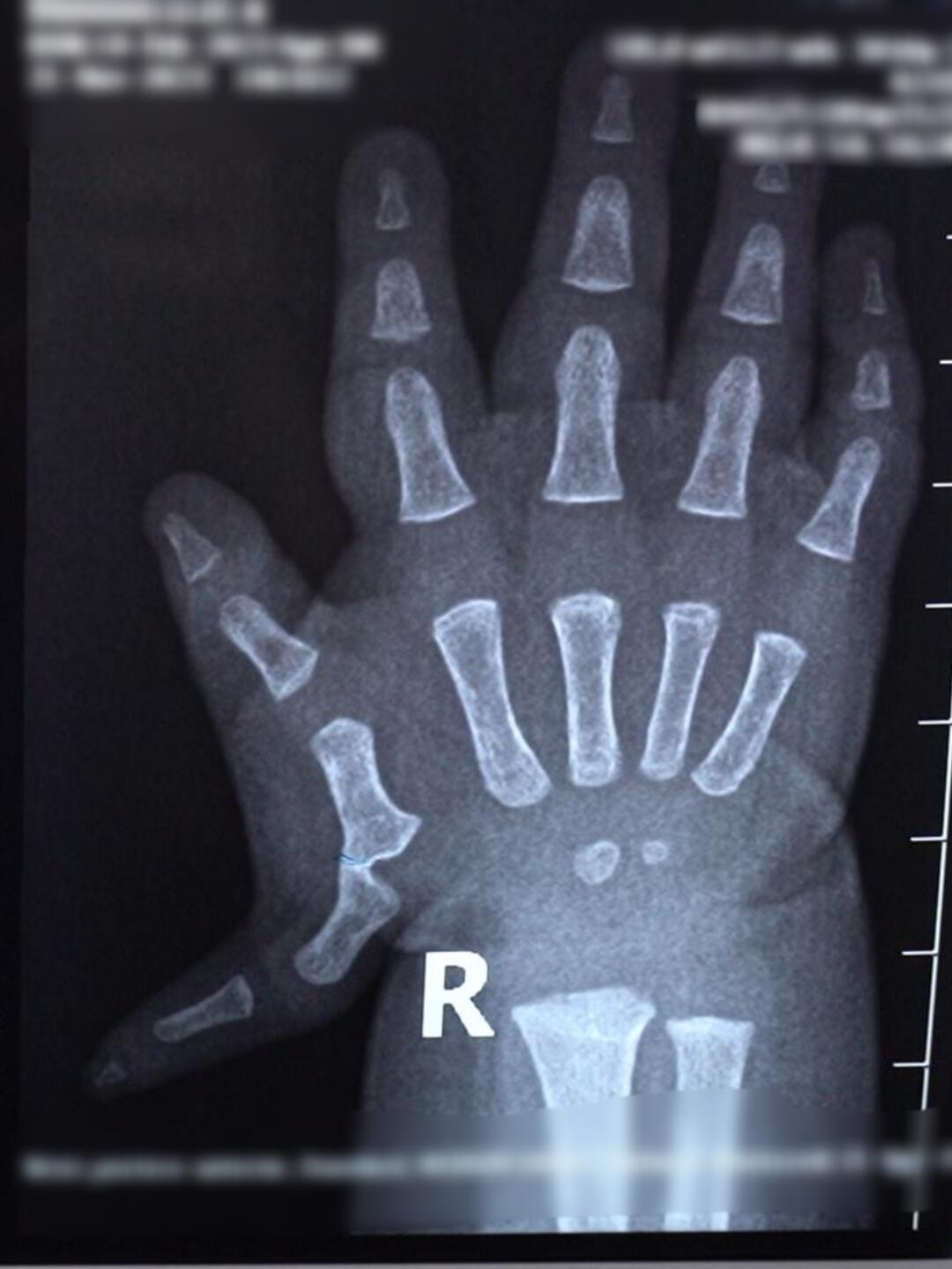 多指它是一个显性遗传疾病,它的病因也是多元化的