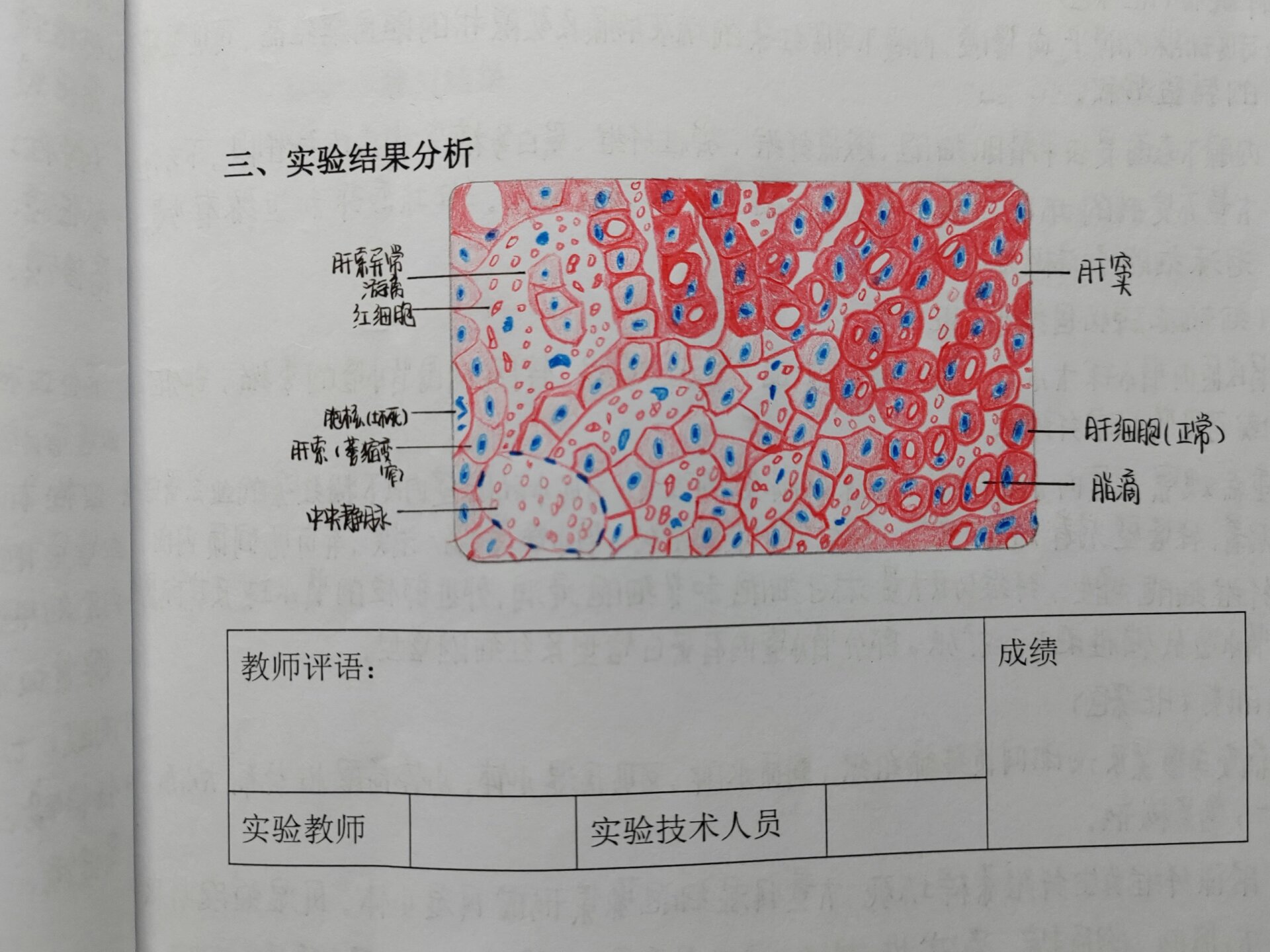 肝淤血图片绘图图片