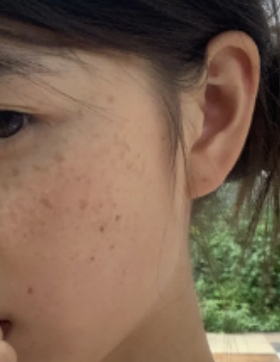 12岁女孩脸上长斑常见原因有以下几种: