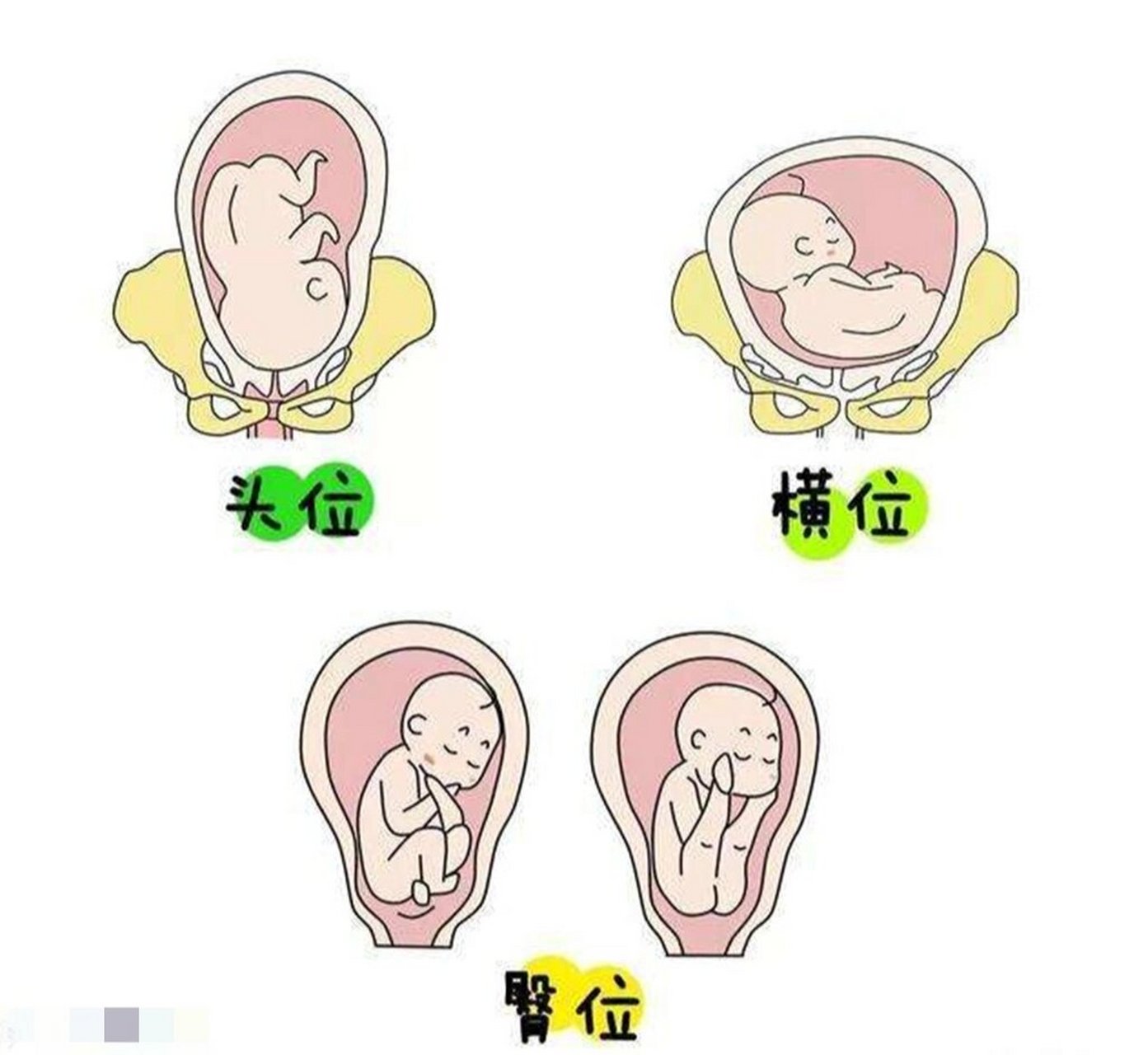 臀位,头位胎动区别是这样滴～ 我是一直臀位,到33周 6成功转成头位