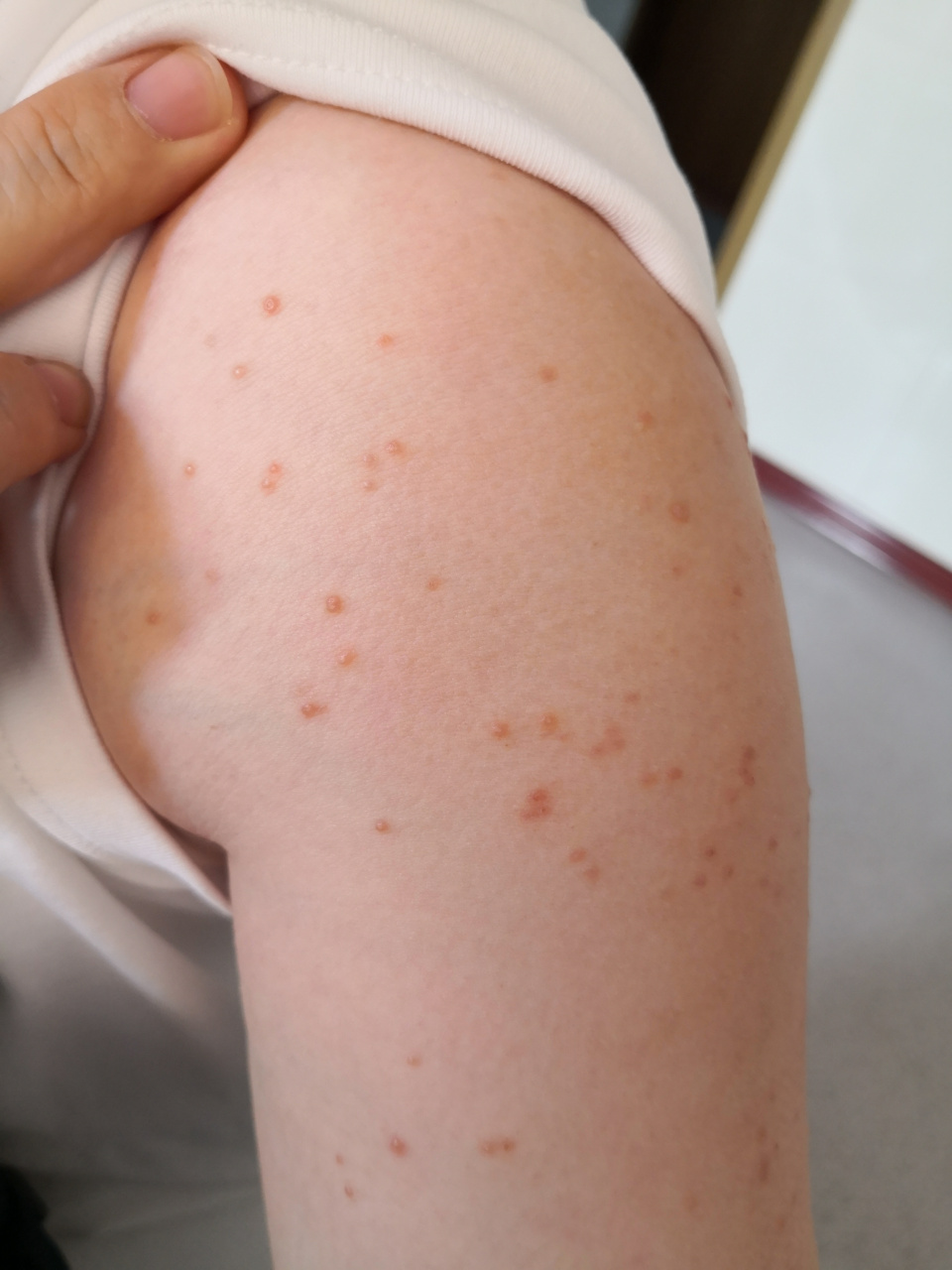 肩部丘疹症状 有的中央有脐窝#传染性软疣