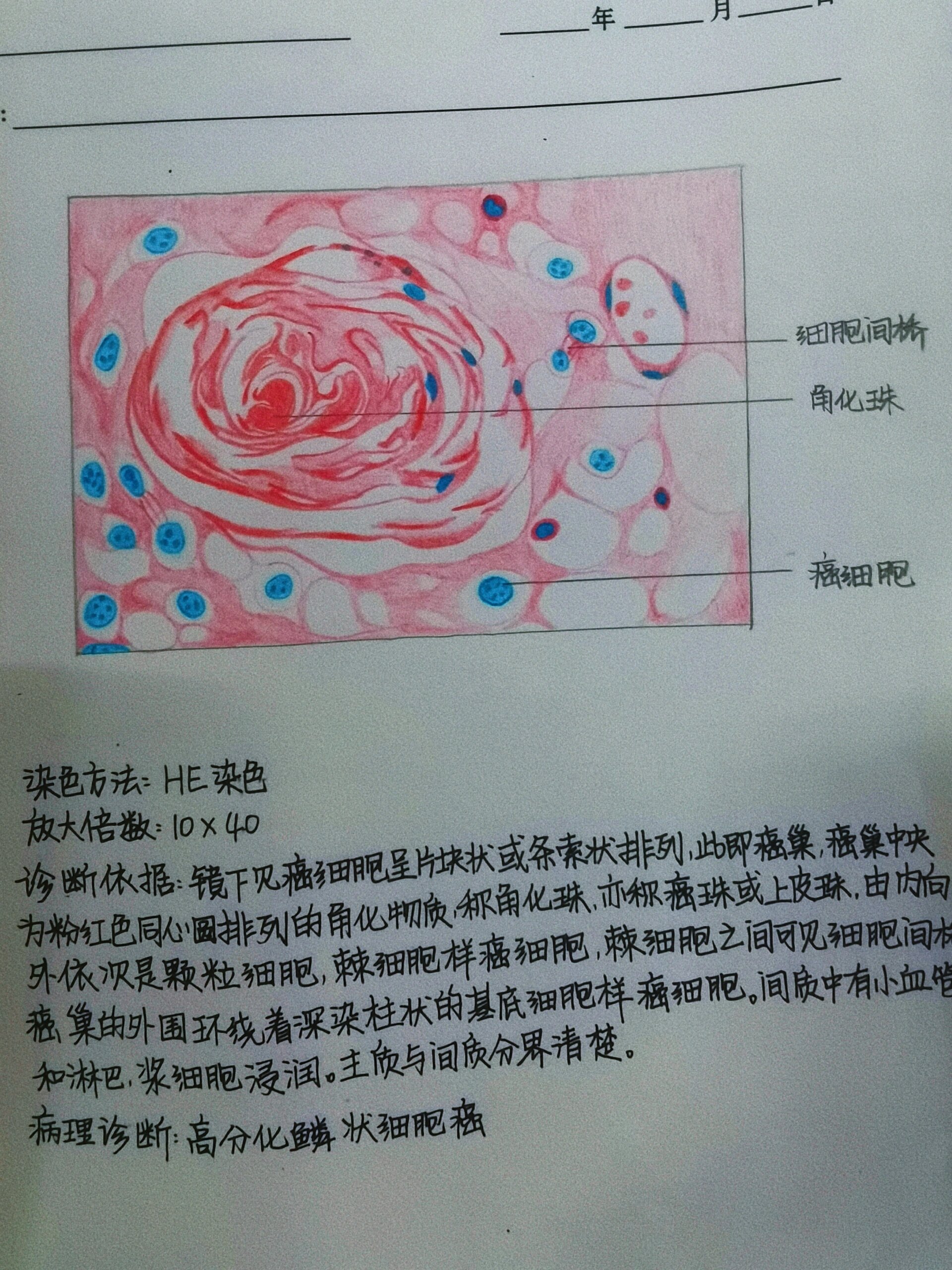 鳞状细胞癌病理绘图图片