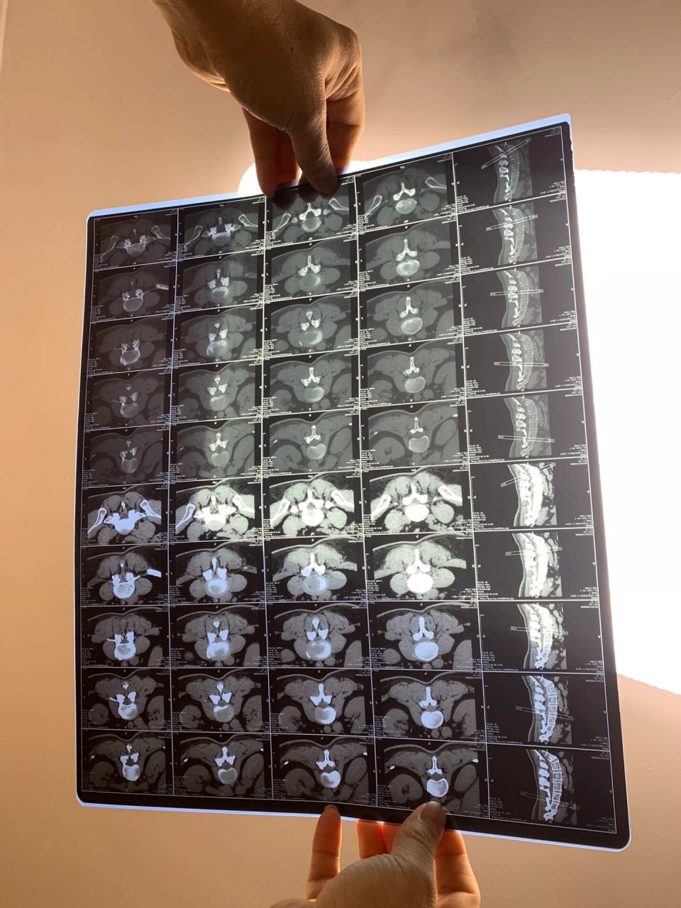 求助 广州哪家医院治疗腰间盘突出比较好?