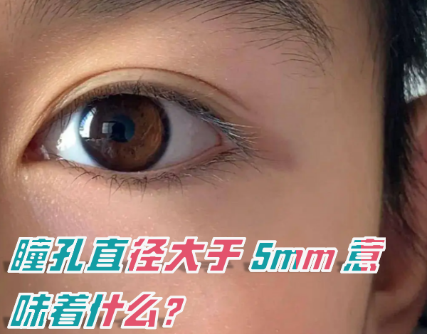 瞳孔直径>5 mm称为散大,常见原因:生理性暗适应,药物散瞳,外沈或