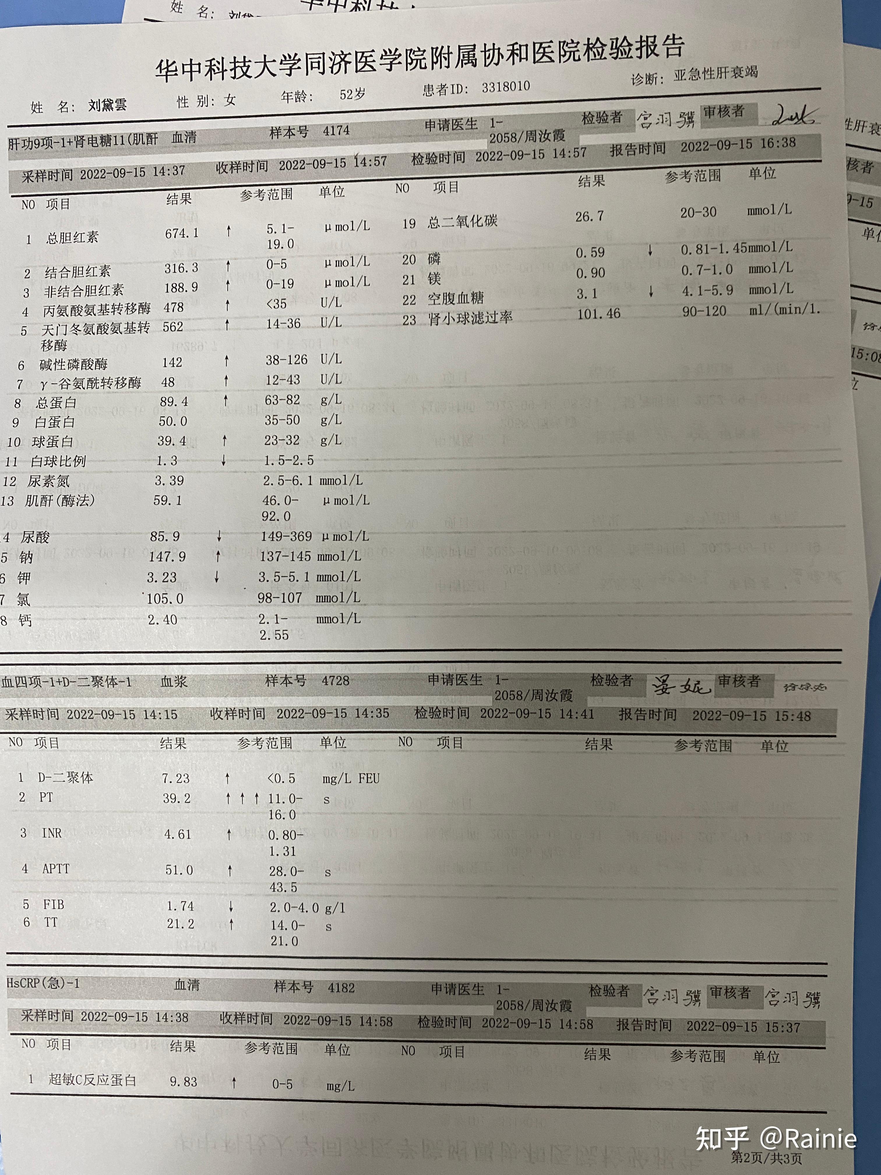 肝衰竭病人图片