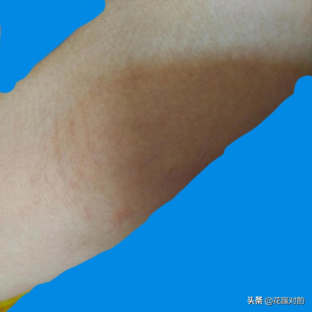 新冠疫苗都打完六天了,皮肤起疹子瘙痒的毛病依然存在,这个过敏什么