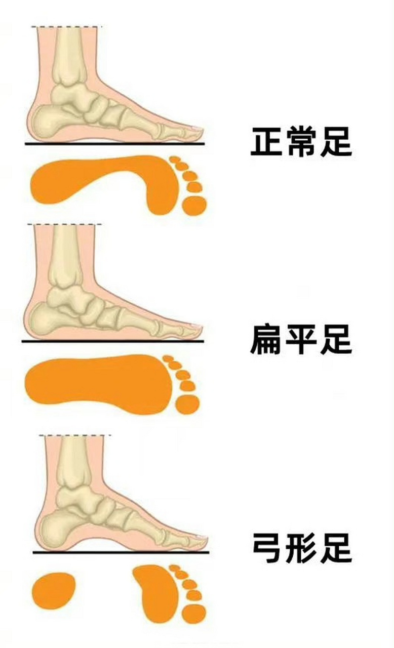 【#你的脚型适合穿什么鞋子#】正常足,扁平足,弓形足,八字足……不同