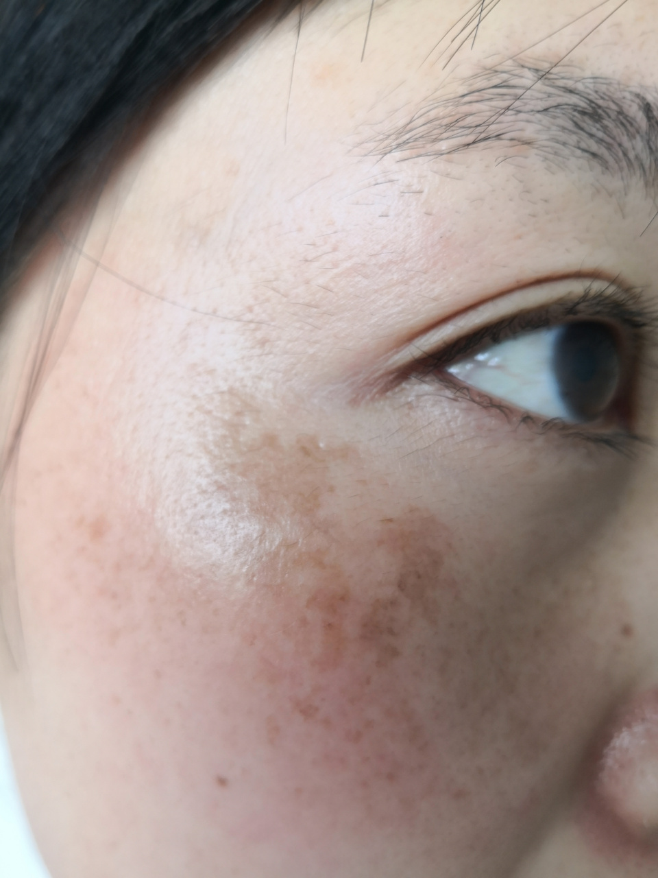 解决皮肤问题专注皮肤美容#黄褐斑