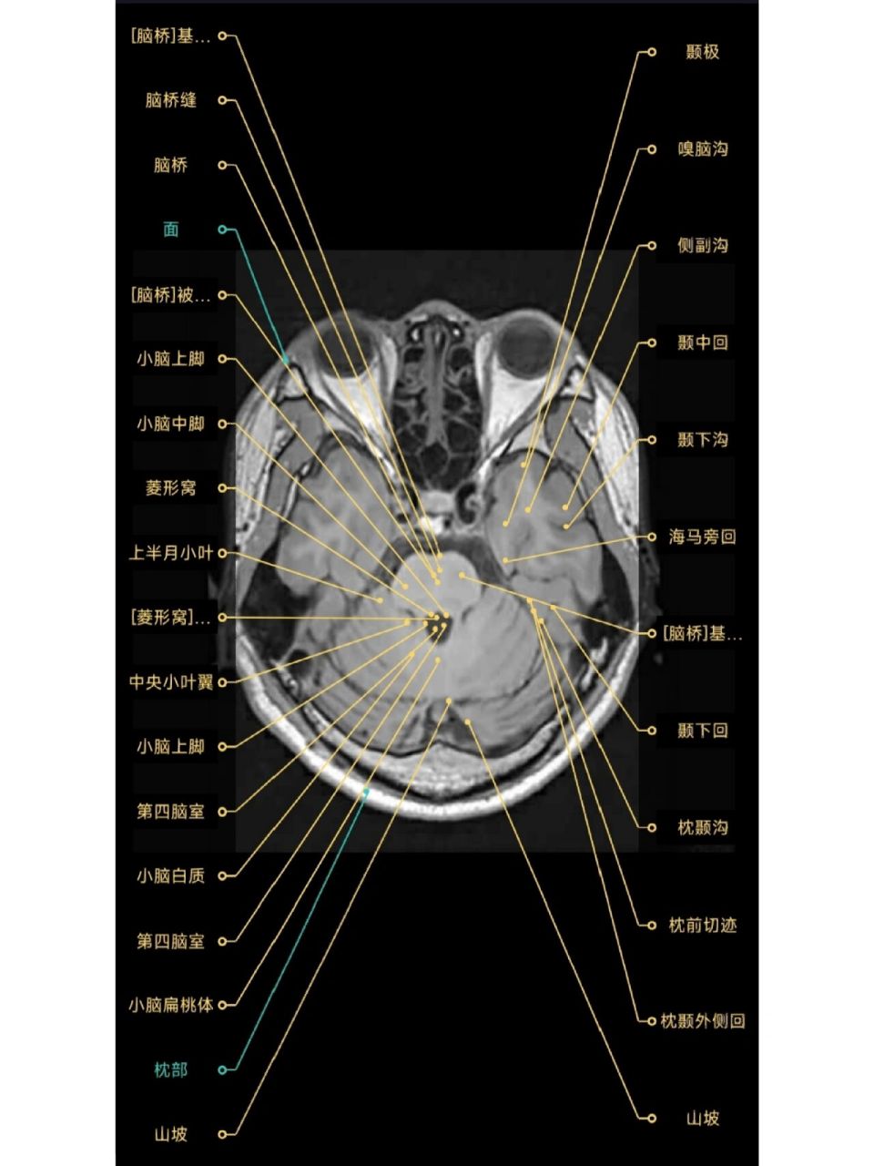 脑干mri断层解剖图图片