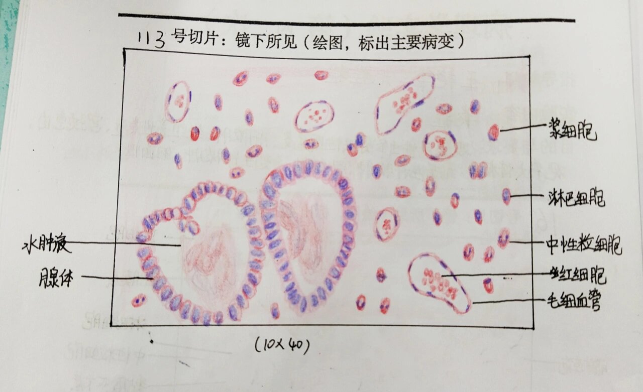 急性阑尾炎切片绘图图片