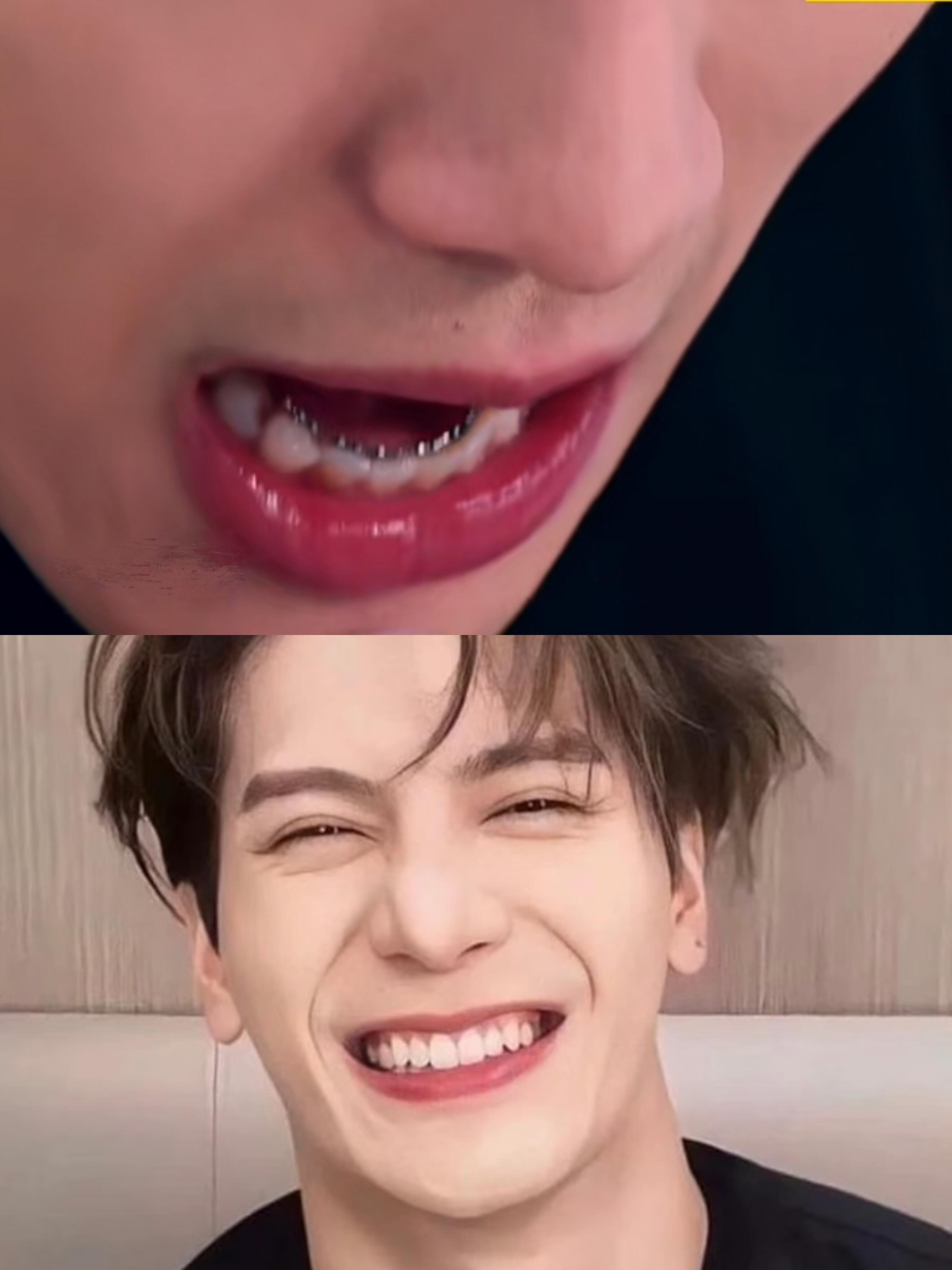 王嘉尔做的舌侧矫正建议男明星男爱豆们都卷起来