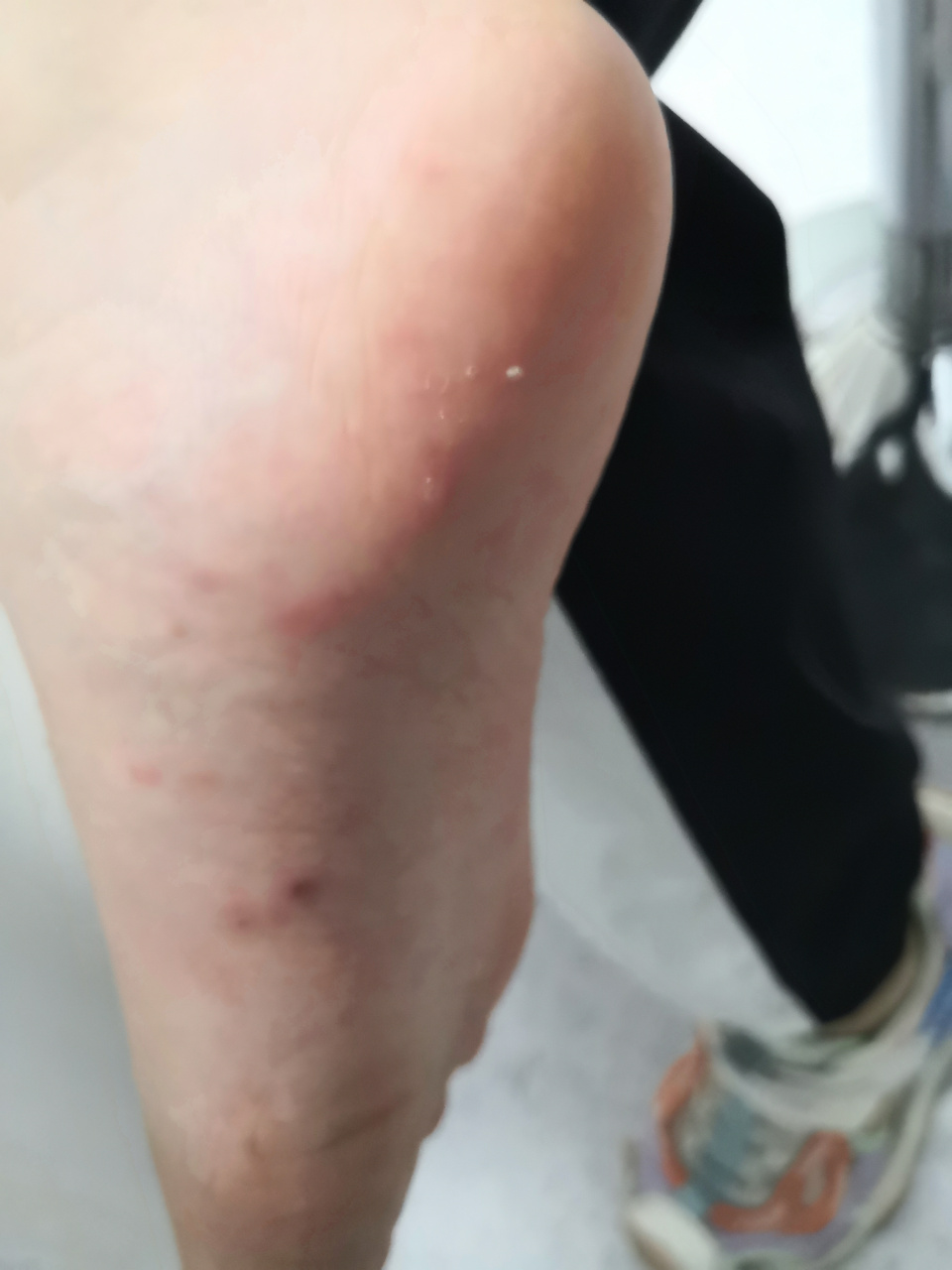 考虑汗疱疹症状#解决皮肤问题专注皮肤美容##汗疱疹