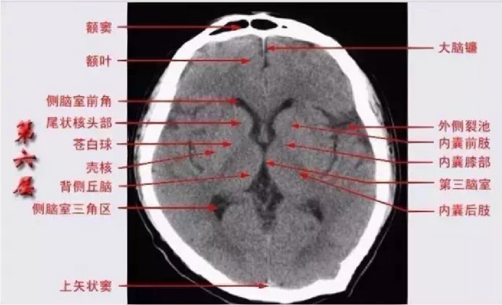 脑干ct解剖图片