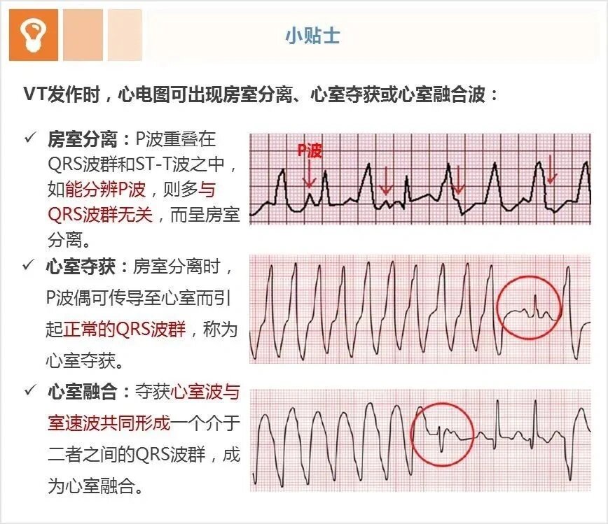 室上速与室速鉴别: ★不同类型svt的心电图表现有所不同,但都有p波(或