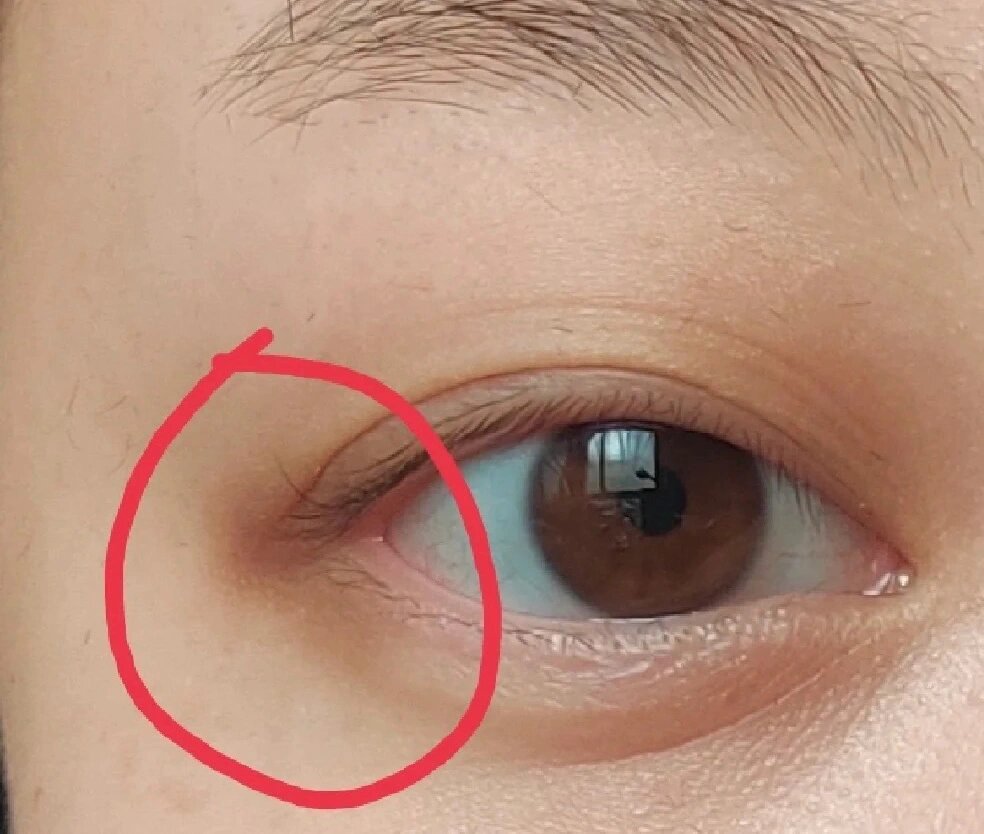 祛眼尾暗沉,色素沉着 应该有很多人有这样的情况吧,眼尾部分像斑一样